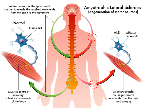 The LVH ALS Foundation What is ALS? - The LVH ALS Foundation